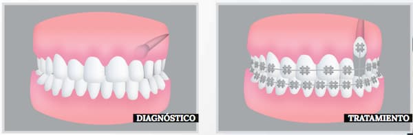 dientes retenidos tratamiento