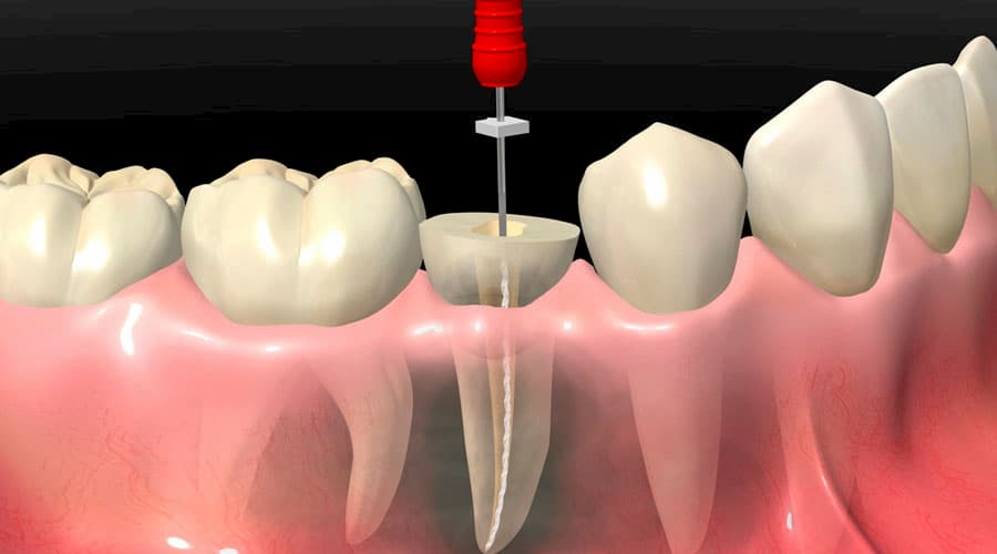 endodoncia en tacna