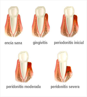 Periodontitis 4 etapas de la periodontitis