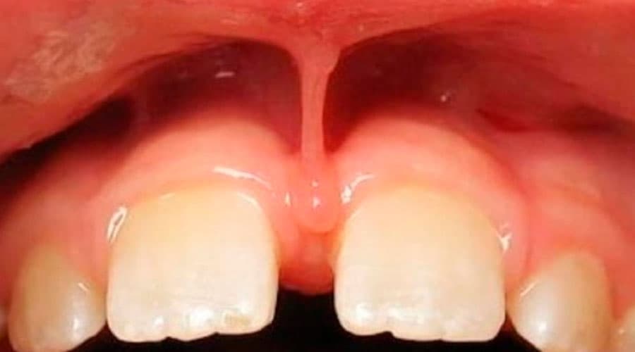 Frenectomía Cirugía del Frenillo Clínica Dental Tacna