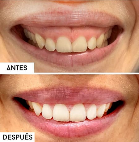 gingivoplastia antes y después