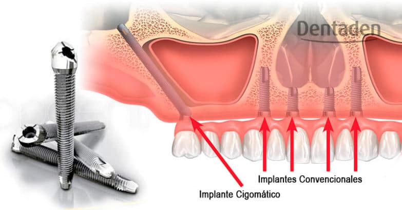 implantes cigomaticos en tacna peru