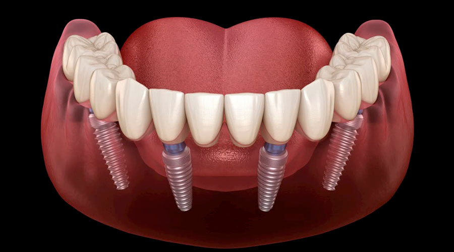 Implantes Dentales All On Four 1 implantes dentales all on four en tacna