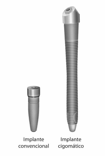 caracteristica de los implantes dentales cigomaticos