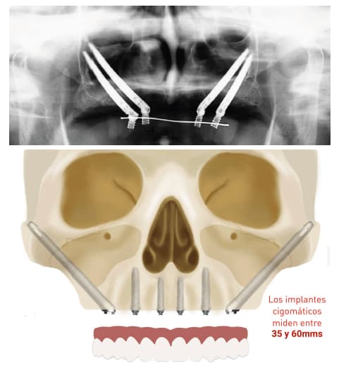 implantes dentales cigomaticos en tacna peru