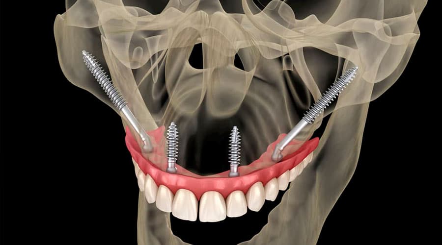 implantes dentales cigomaticos en tacna