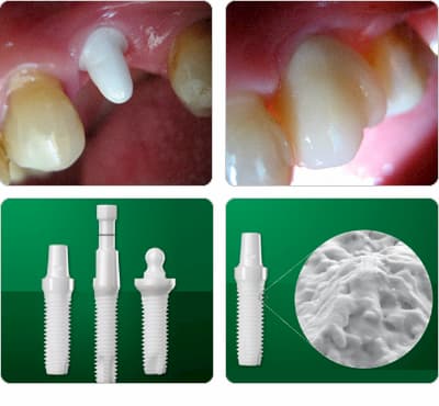 Implantes Dentales de Zirconio 4 implantes dentales de zirconio ventajas