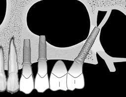 Implantes Dentales Pterigoideos 3 implantes dentales pterigoideos