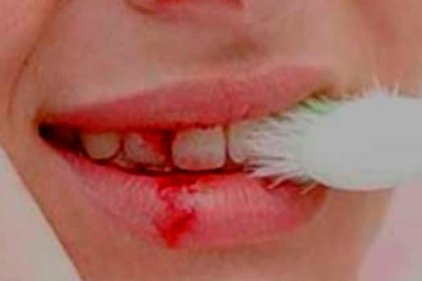 Encías Retraídas 3 mala practica de cepillado