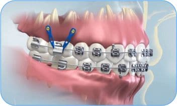microimplantes en tacna peru