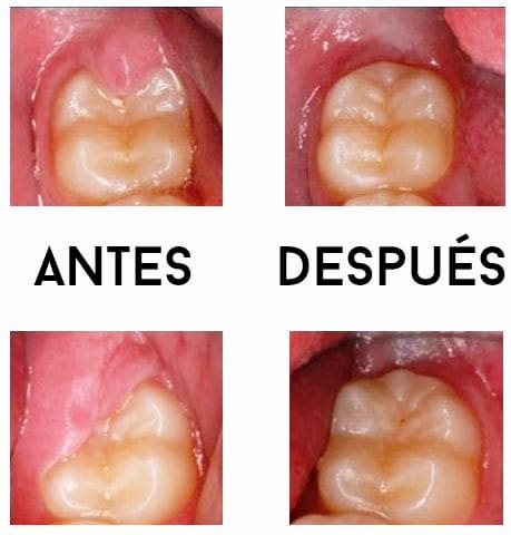 operculectomia antes y despues