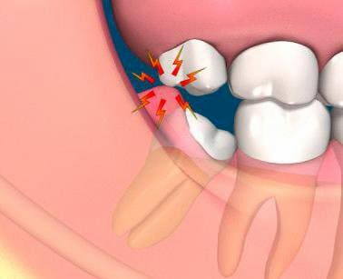 pericoronaritis