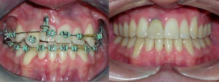 ortodoncia en tacna antes y despues