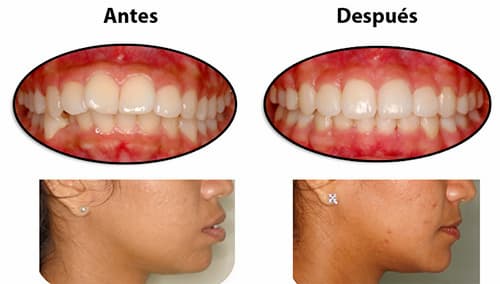 ortodoncia estética antes y depues 