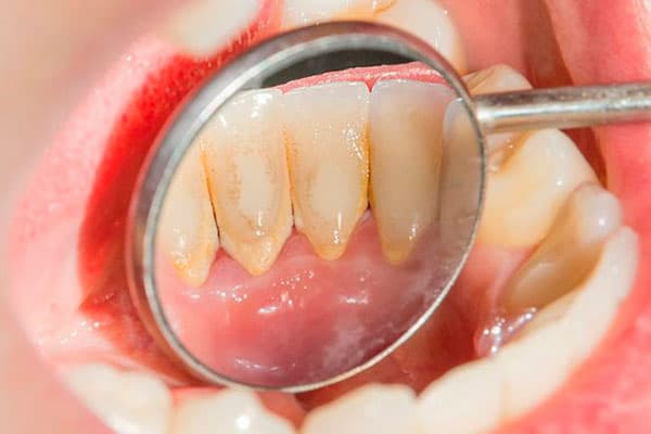 Periodontitis Enfermedad De Las Encías Clínica Dental Tacna