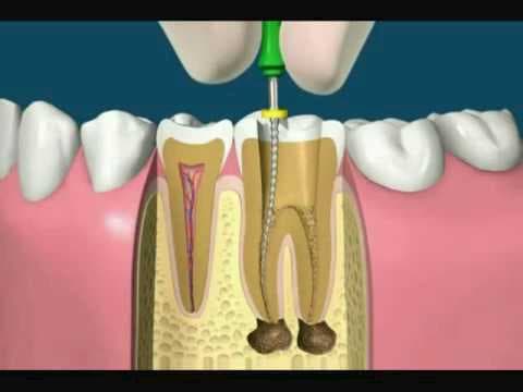 reendodoncia