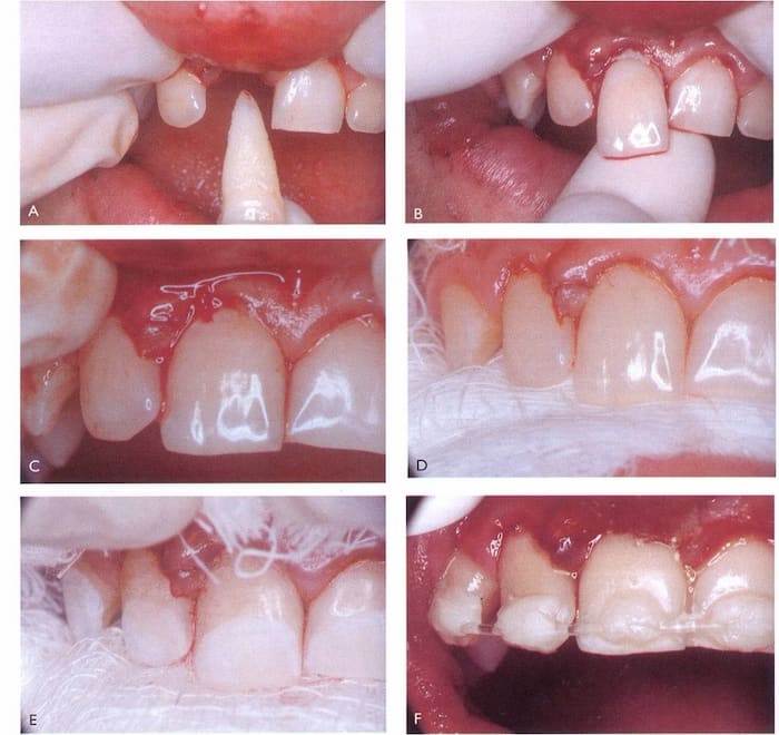 Reimplante Dentario 3 reimplante dentario procedimiento