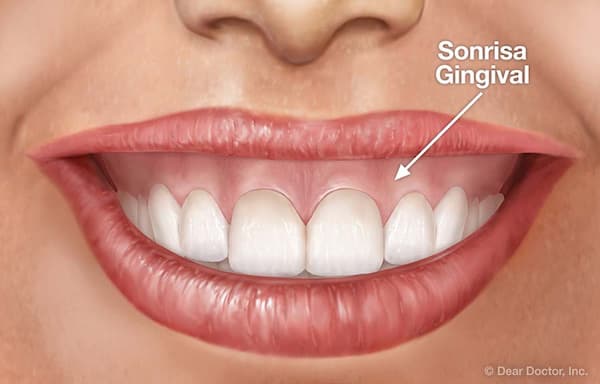 sonrisa gingival