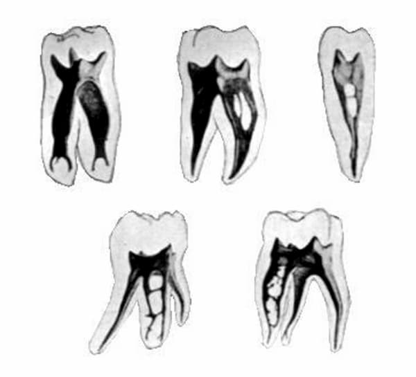 tipos de endodoncia