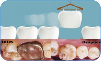 transplante dental