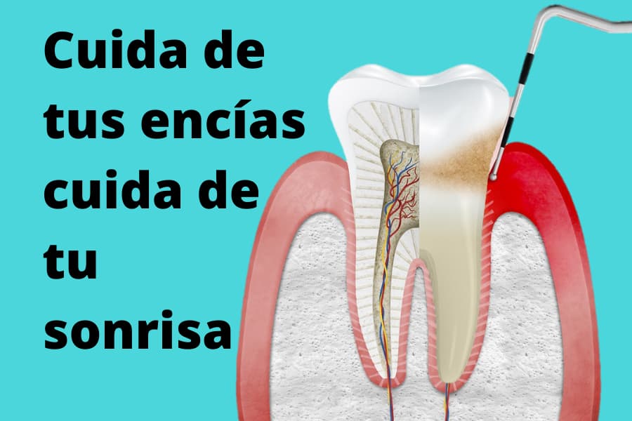 como se cura la gingivitis