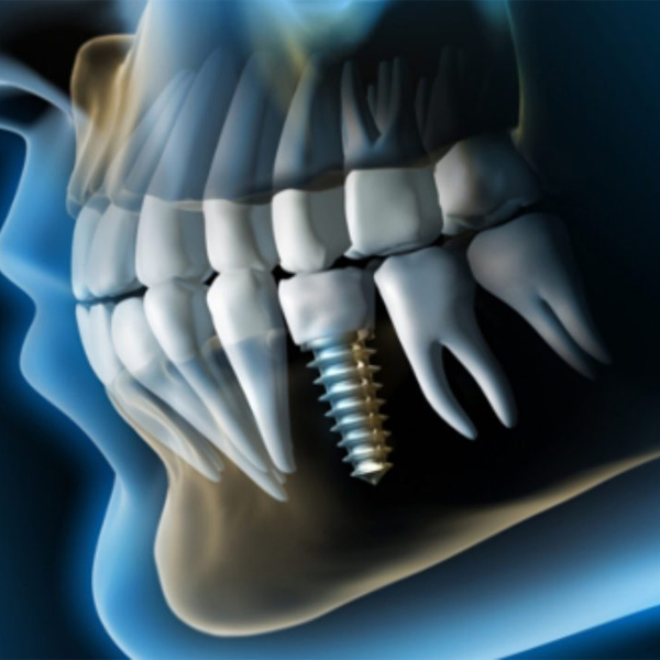 Tiempo de recuperación después de implantes dentales 8