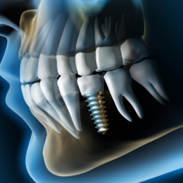 Tiempo de recuperación después de implantes dentales 4 Tiempo de recuperación después de implantes dentales 3