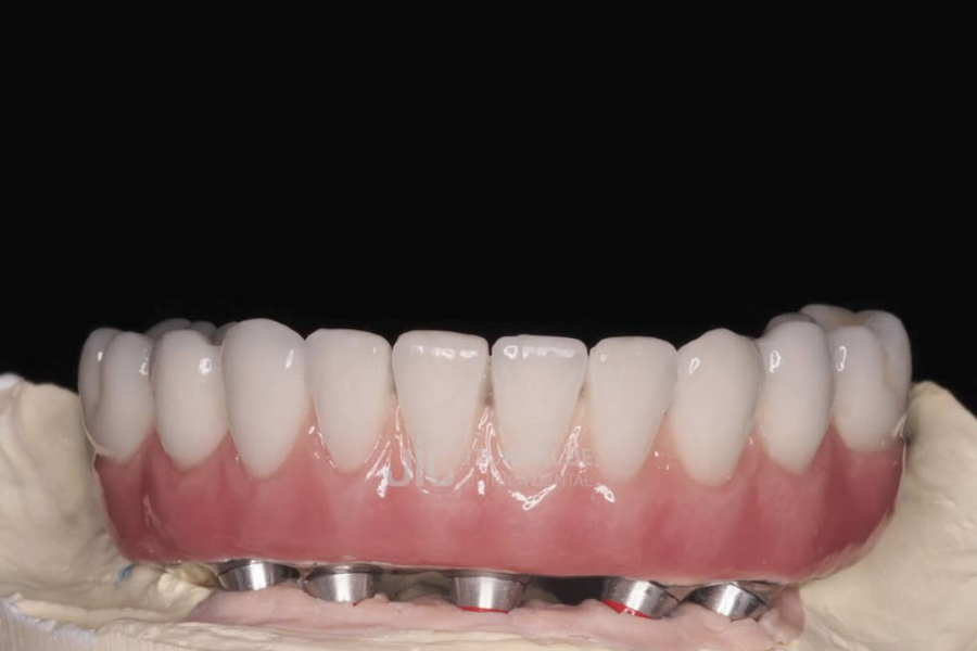¿Cómo limpiar una prótesis dental? 10